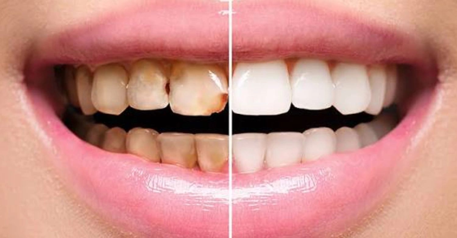 Rotten teeth In blog